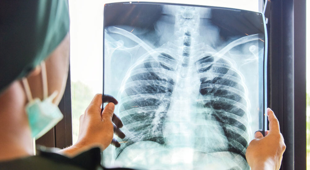 Chest-X-Rays---Royalty-Occupational-Health